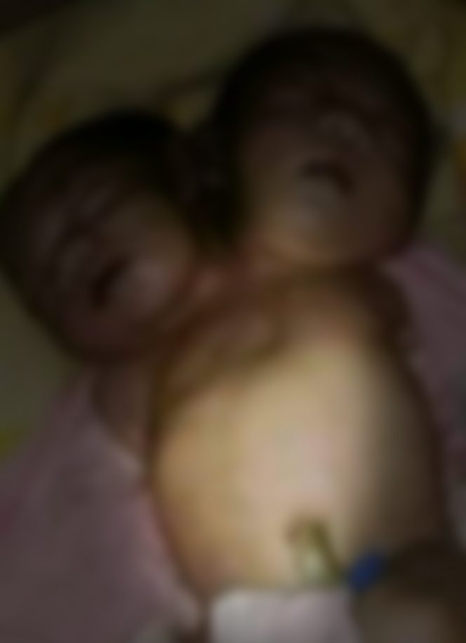 
					Tak Tertolong, Bayi Perempuan Berkepala Dua di Rote Ndao Meninggal Dunia